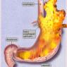 Anonymous-Foods-To-Avoid-Acid-Reflux